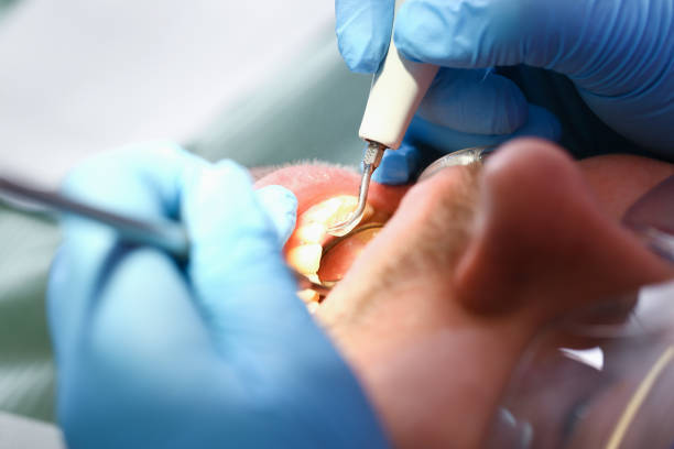 Best Emergency Wisdom Teeth Removal in Moorpark, CA