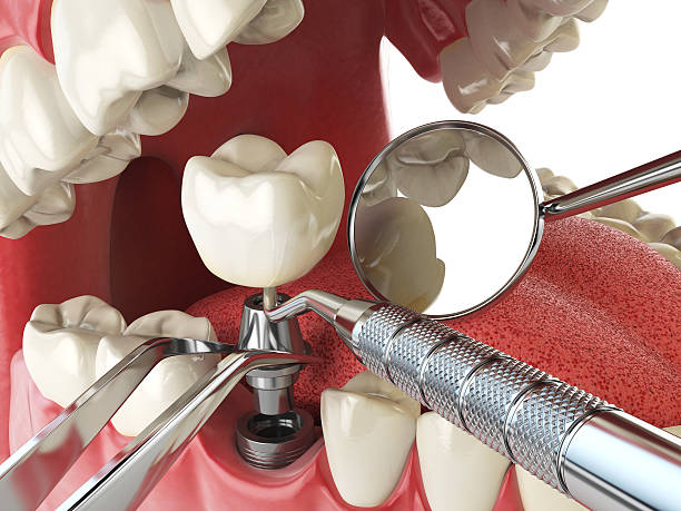 Best Emergency Treatment for Dental Infections or Abscesses in Moorpark, CA